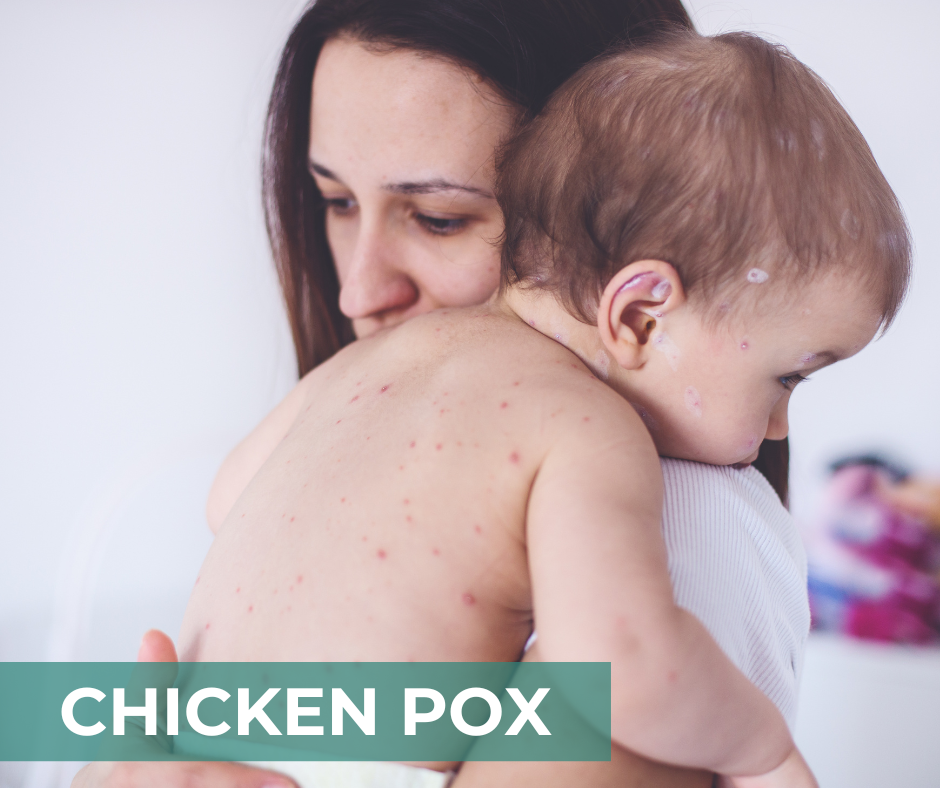 Chicken Pox - CIDP