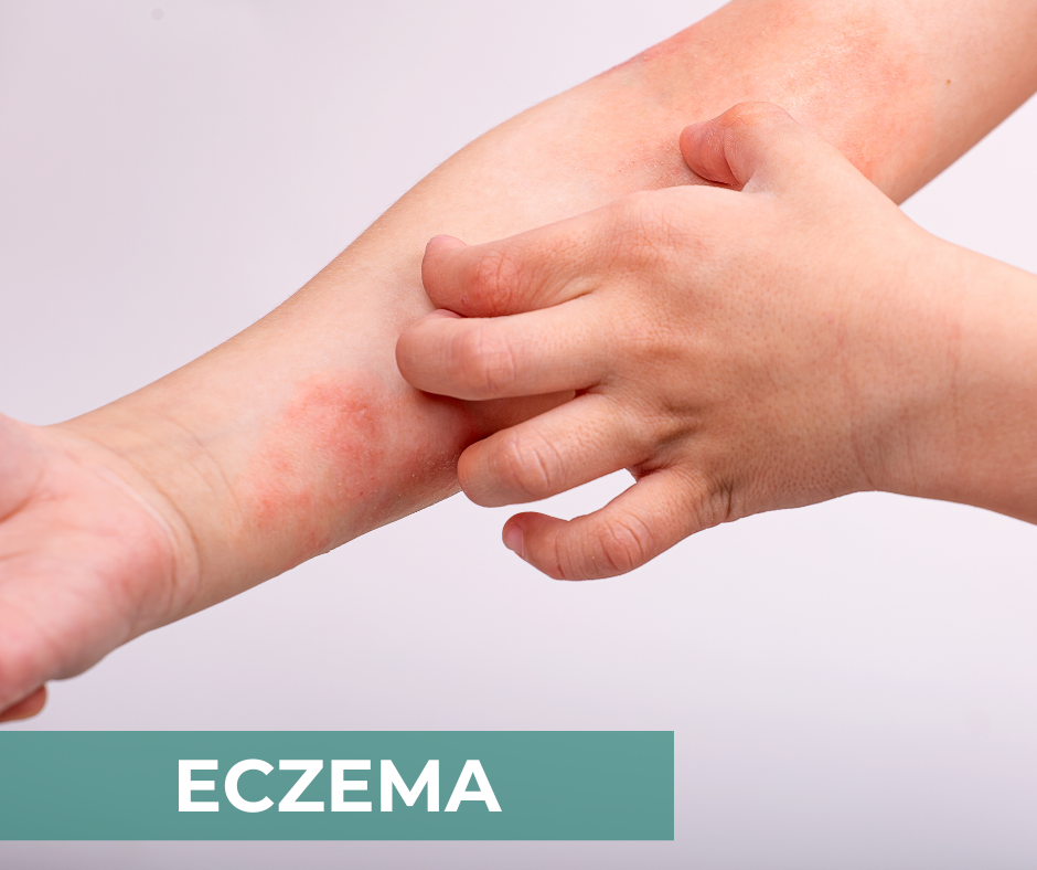 Atopic Dermatitis (Eczema) - CIDP