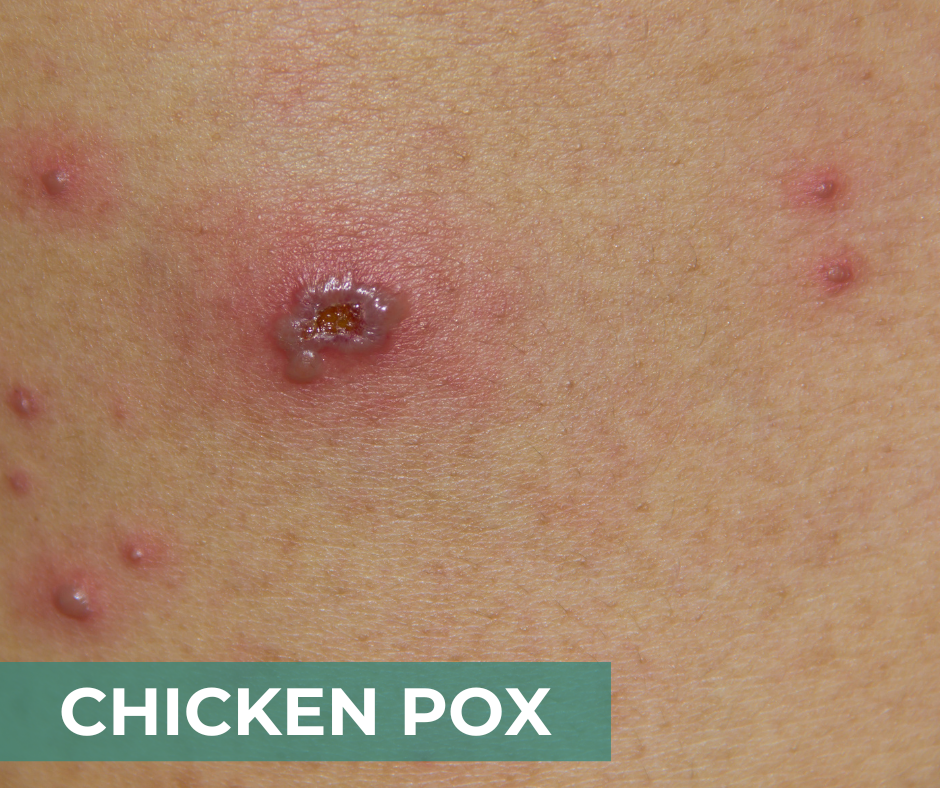 Chicken Pox - CIDP