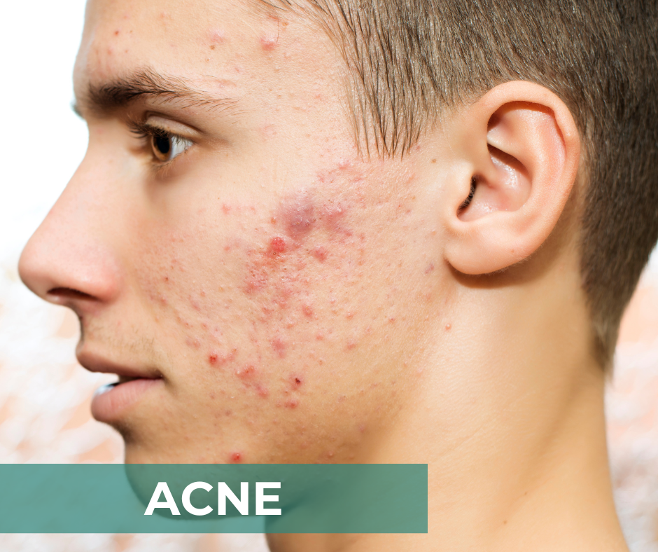 Acne - CIDP